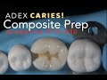 Class II Composite Preparation for ADEX Caries #30 MO