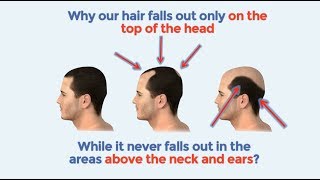 Full Hd Hair Loss Treatment Direct Download And Watch Online