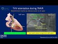 Dr. Adam Greenbaum Presents "Transcatheter Valve-in-valve And Ring-in-valve Replacement"