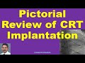 Pictorial Review of CRT Implantation