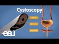 Cystoscopy (overactive bladder)