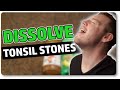Dissolve Tonsil Stones At Home With Only 3 Ingredients