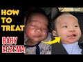 How to treat BABY ECZEMA 100% Effective and Organic!