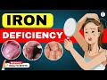 10 Weird Signs You're Low on Iron | Iron Deficiency Anemia | Iron Deficiency Symptoms