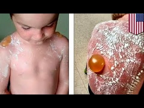Волдыри на коже после ожога на солнце Волдыри на коже после ожога на солнце