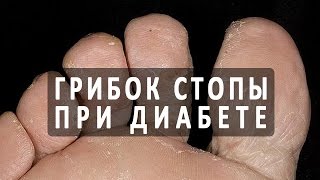 Ногти на ногах у диабетиков