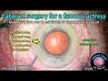 CataractCoach™ 2185: surgery for a famous actress