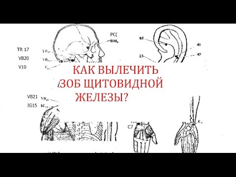 Как лечить зоб щитовидной железы чистотелом Как лечить зоб щитовидной железы чистотелом