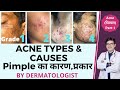 Acne Types and Causes In Hindi | Acne Types with Pictures | Pimple Ke Prakar | Dr Sunil
