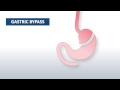 What is gastric bypass surgery? | Beaumont Health