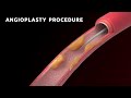 Penile Angioplasty: The Best Treatment for Erectile Dysfunction