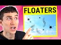 Large Eye Floaters Explained - Posterior Vitreous Detachment (PVD)