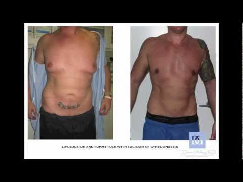 Breast reduction west palm beach