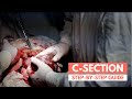 What to expect during a C-section | Real Footage