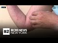 Mpox cases spiking in NYC, health department says