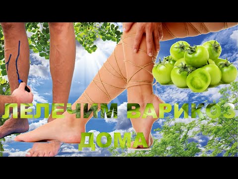 Как лечить варикоз домашнее условиях Как лечить варикоз домашнее условиях