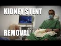 Post Kidney Transplant Stent Removal | Men's Cystoscopy procedure