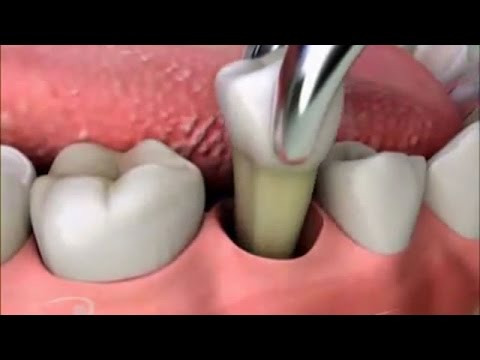 После удаления зуба черное внутри 54