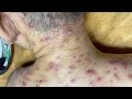 Acne Treatment With Sac Dep Spa #04