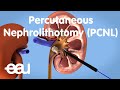 Removal of kidney stones: PCNL