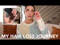 MY HAIR LOSS JOURNEY | SIGNS OF HAIR LOSS | ANDROGENIC ALOPECIA | FEMALE HAIR LOSS JOURNEY