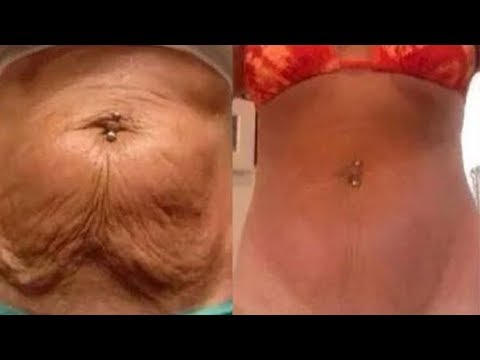 Haut am bauch