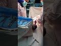 18 June 2020   cesarean section in shomal hospital