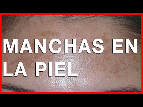 Después del autobronceado había unas manchas de pigmento