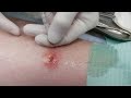 Как удалить стержень из фурункула в домашних условиях Как удалить стержень из фурункула в домашних