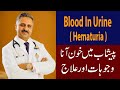 Blood in Urine ( Hematuria) , Causes & Treatment.