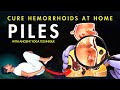 Piles Problem Treatment | Yoga for Piles | Cure Hemorrhoids with Simple Exercises #piles