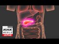 Destroying Pancreatic Cancer with Ultrasound - Medical Frontiers