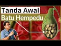 Batu Karang Hempedu | 5 Tanda Awal Wajib Tahu | Doctor Sani |