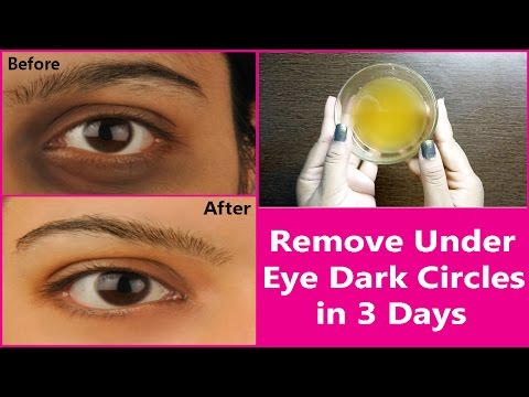 Dark Circles Under Eye Treatments Remedies