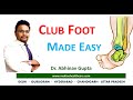 Congenital Talipes Equinovarus Varus (CTEV) - Club foot - Made easy with Dr. Abhinav Gupta