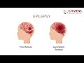 Epilepsy can effectively manage their condition by identifying common seizure triggers?