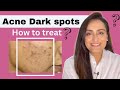 Acne Dark Spots | हिंदी | How to treat | serum cream recommendations | Dermatologist | Dr. Aanchal