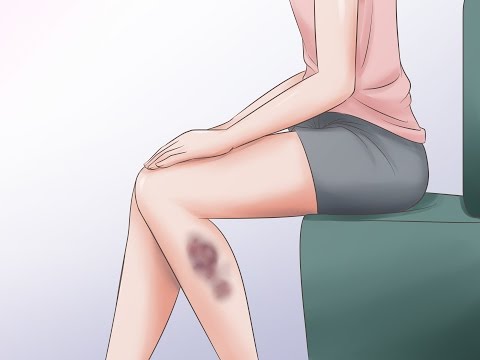 Как быстро сделать что бы синяки прошли Как быстро сделать что бы синяки прошли