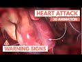 Recognizing a heart attack | 3D Animation