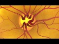 Animation: Dilated Eye Exam