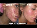 DOES ACCUTANE ACTUALLY WORK? | Products I use post accutane … are these products working?