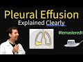 Pleural Effusions - Causes, Diagnosis, Symptoms, Treatment