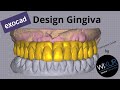 How To Design Gingiva - Exocad Full-Arch Case