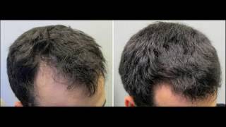 Full Hd Regrowth Of Lost Hair Naturally Direct Download And Watch