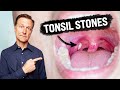 What CAUSES Tonsil Stones and How to Prevent Them