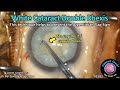 CataractCoach™ 2182: white cataract double rhexis technique
