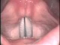 Stroboscopy: Rigid: vocal slide down in female