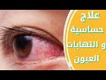 علاج حساسيه العين | التهاب الملتحمه الفيروسي| التهاب الملتحمه البكتيري | الحلقه 15 من كورس OTC
