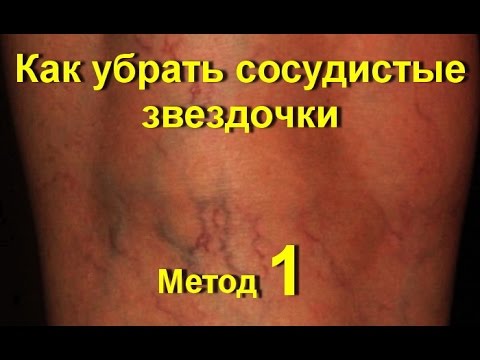 Как избавится от сосудистых звездочек на ногах в домашних условиях Как избавится от сосудистых звездочек на ногах в домашних условиях