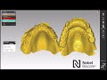 How to design your NobelProcera® full arch cases using iCam and exocad™